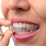 Ortodoncia Invisible Invisalign - la sonrisa transparente - Colocación